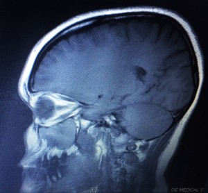 MRI scan of a human brain (mine)